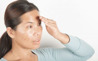Melasma: Enfermedad que produce manchas simétricas principalmente en la cara